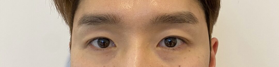 道言録院長非切開手術後期.!