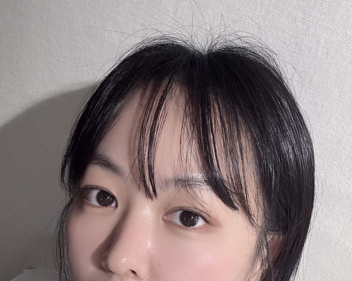 金洪振院长- 自然粘连+上眼角  