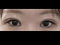 ศัลยกรรมตกแต่งดวงตา Ilmiri