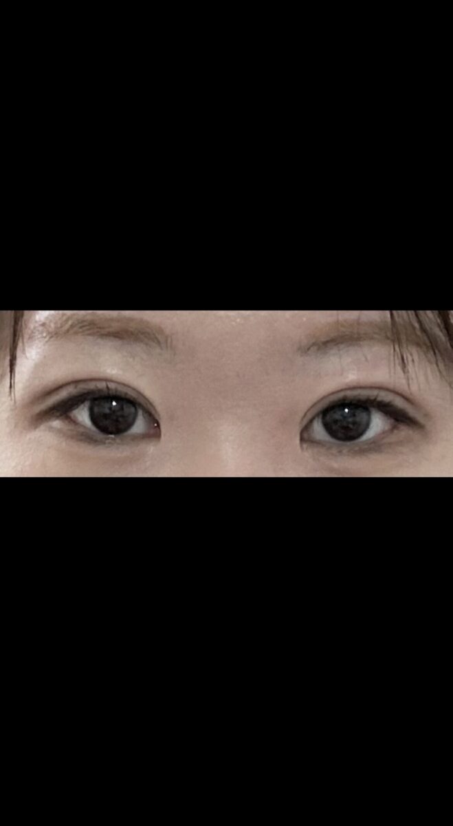 イルミリ整形外科目再手術