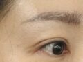 一毫米  全切双眼皮 术后反馈