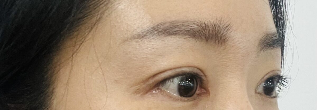 一毫米  全切双眼皮 术后反馈
