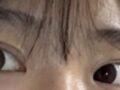 ศัลยกรรมตกแต่งเปลือกตาสองชั้น 1 มม.