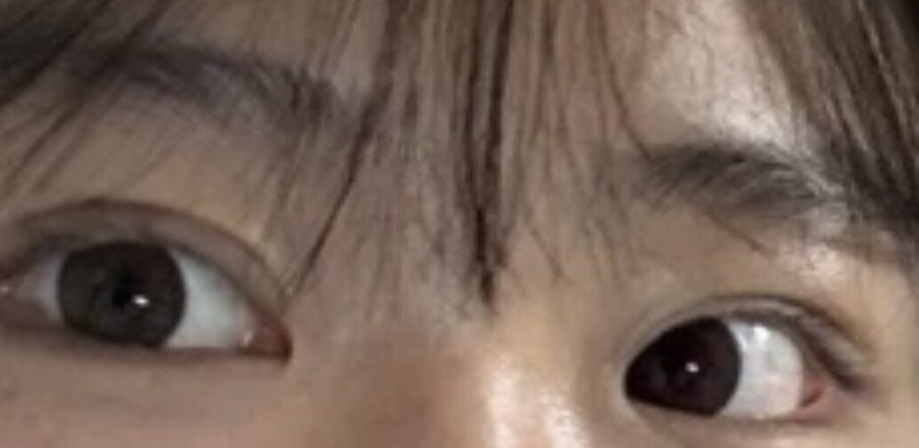 ศัลยกรรมตกแต่งเปลือกตาสองชั้น 1 มม.