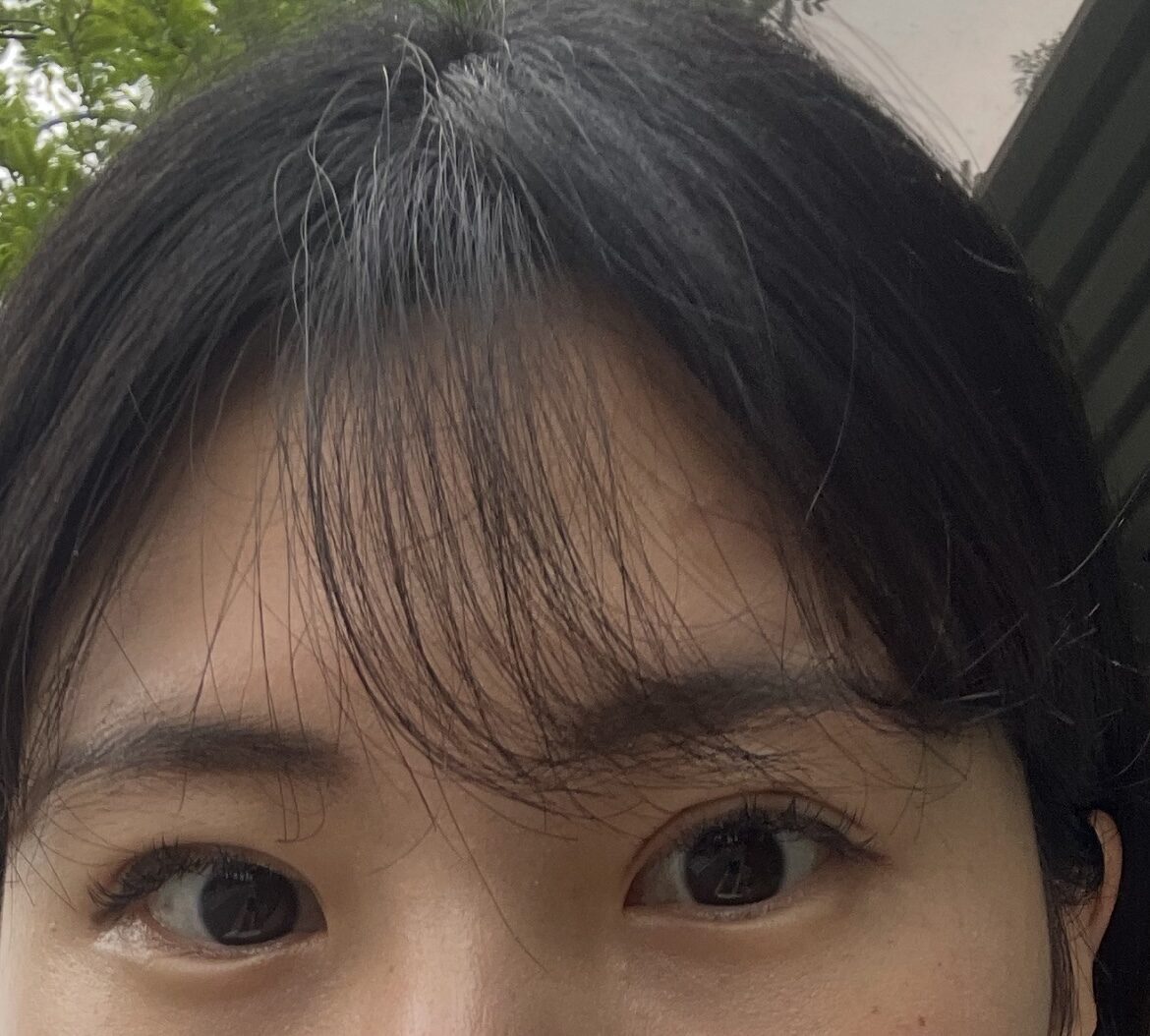 การยกเปลือกตาบน + การยึดติดอย่างเป็นธรรมชาติ