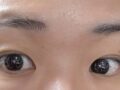 รีวิวการผ่าตัดเปิดแผลและศัลยกรรมเปลือกตาบน โดยผู้อำนวยการ โด ออน-ร็อก ที่คลินิกอิลมิริ