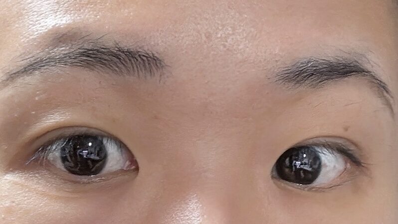 รีวิวการผ่าตัดเปิดแผลและศัลยกรรมเปลือกตาบน โดยผู้อำนวยการ โด ออน-ร็อก ที่คลินิกอิลมิริ