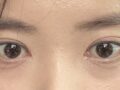 รีวิวการผ่าตัดแก้ไขความไม่สม่ำเสมอของดวงตา 1 มม.