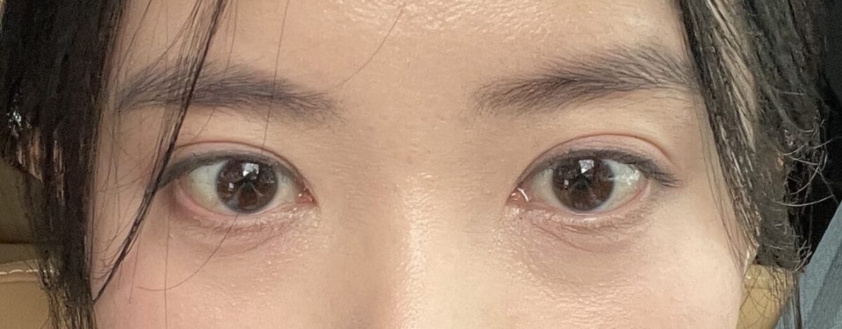 一見交尾した自然癒着手術のレビュー