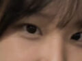 การผ่าตัดตกแต่งหัวตา 1 มม. + ศัลยกรรมทำตาสองชั้น