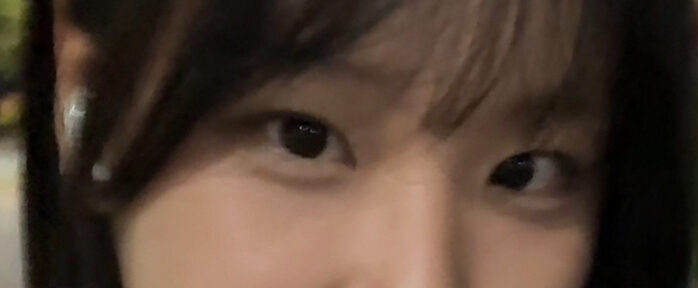การผ่าตัดตกแต่งหัวตา 1 มม. + ศัลยกรรมทำตาสองชั้น