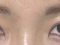 3 เดือนหลังการปลูกถ่ายไขมันเปลือกตาบนและการผ่าตัดทำตาสองชั้นแบบไม่กรีดแผล โดยผู้อำนวยการโด ออน-ร็อก ที่คลินิกอิลมิริ