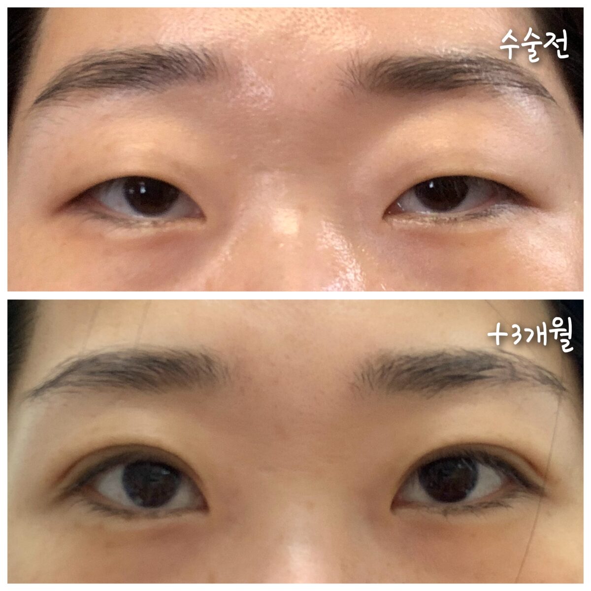 ฉันพอใจกับการผ่าตัดแก้ไขเปลือกตาแบบเต็มรูปแบบโดยคุณหมอคิม ฮงจิน ที่คลินิกอิลมิริ เมื่อ 3 เดือนที่แล้วค่ะ