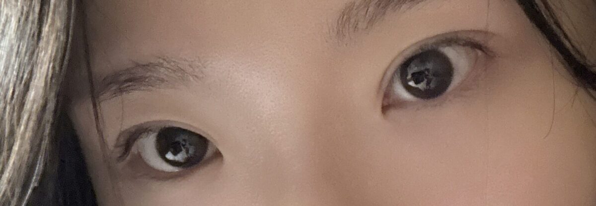 一毫米自然粘连  术后反馈