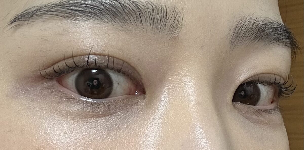 แก้ไขแผลผ่าตัดขนาด 1 มม. + ยกเปลือกตาบน + ยกเปลือกตาล่าง