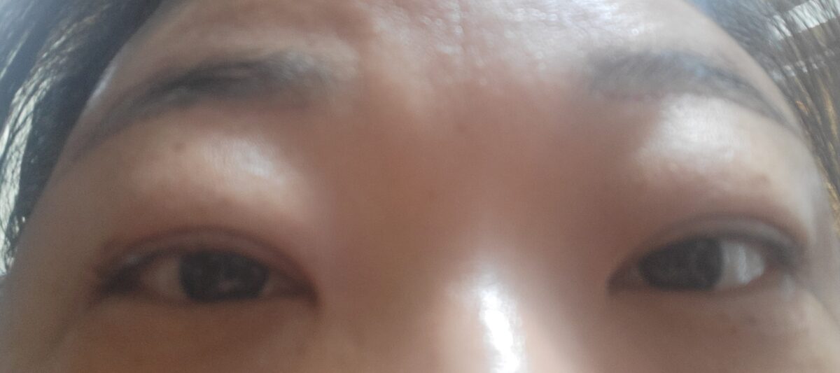 双眼皮+切眉提升 手术
