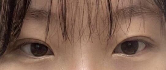 ศัลยกรรมตกแต่งเปลือกตาแบบธรรมชาติ โดย คิม ยุน-ฮยอน ผู้อำนวยการ Ilmiri