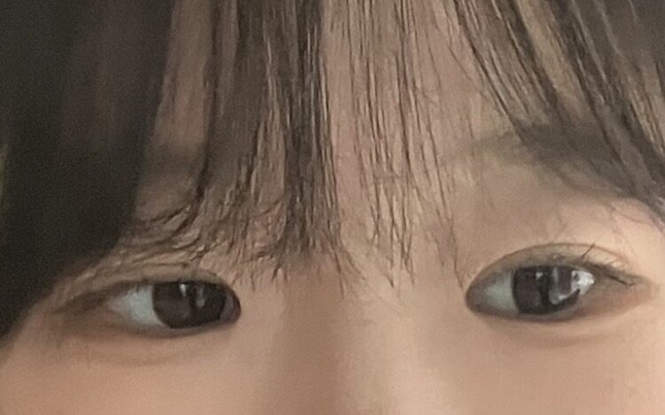 都彦禄院长 - 埋线双眼皮+前眼角