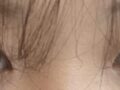 ศัลยกรรมตกแต่งตาแบบไม่ต้องกรีดแผล 1 มม. + ยกกระชับเปลือกตาบน