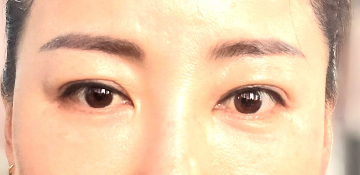 双カップル手術