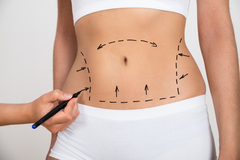 Do I Really Need to Wear a Compression Garment After Liposuction? (1mm Plastic Surgery)