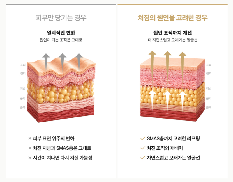 1mm Plastic Surgery Facefit Mini-Lift