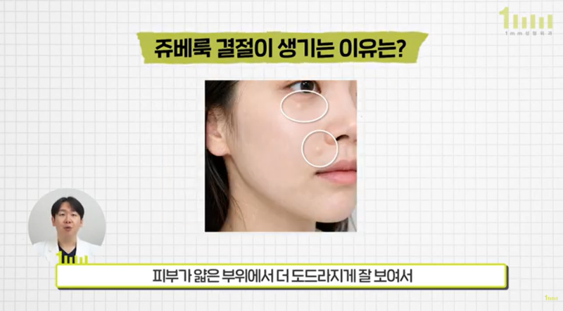 How to Prevent Juvelook Nodules? 1mm Plastic Surgery 사진 6