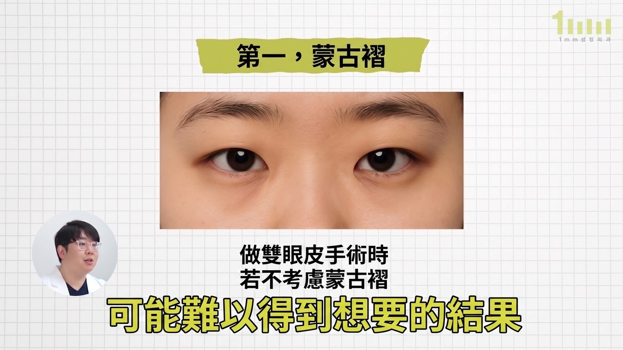正面拍攝的帶有蒙古褶的雙眼照片，配有影片字幕「做雙眼皮手術時若不考慮蒙古褶，可能難以得到想要的結果」