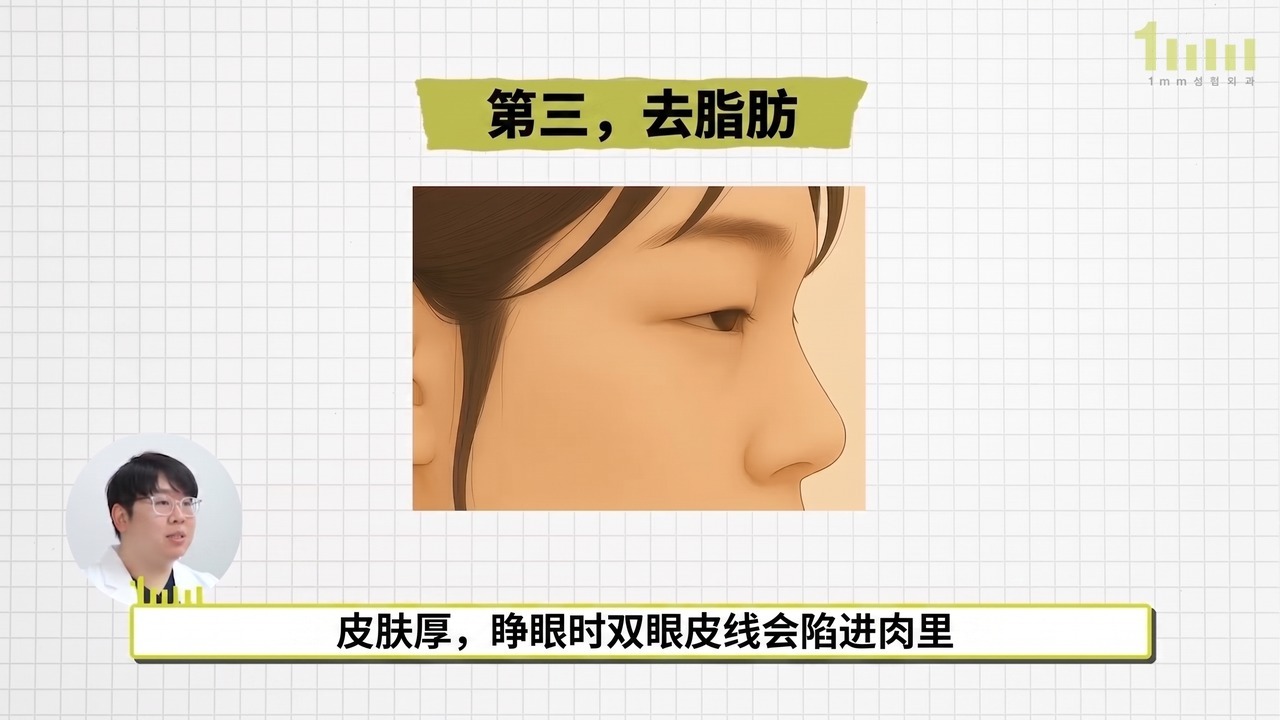 侧面视角的上眼皮厚重的脸部插图，配有视频字幕“皮肤厚，睁眼时双眼皮线会陷进肉里”