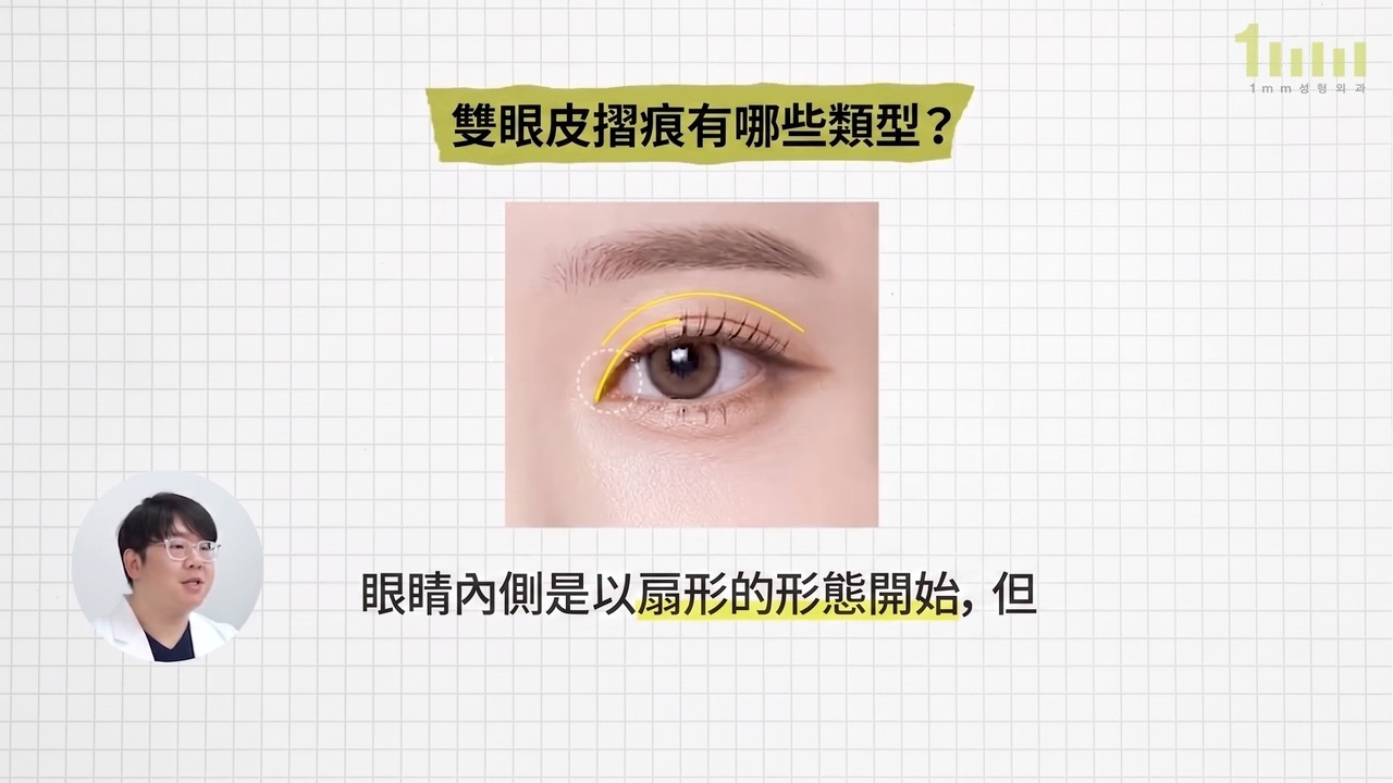 從內眼角內側開始的雙眼皮摺痕以黃線標示的圖片，配有影片字幕「眼睛內側是以扇形的形態開始，但…」