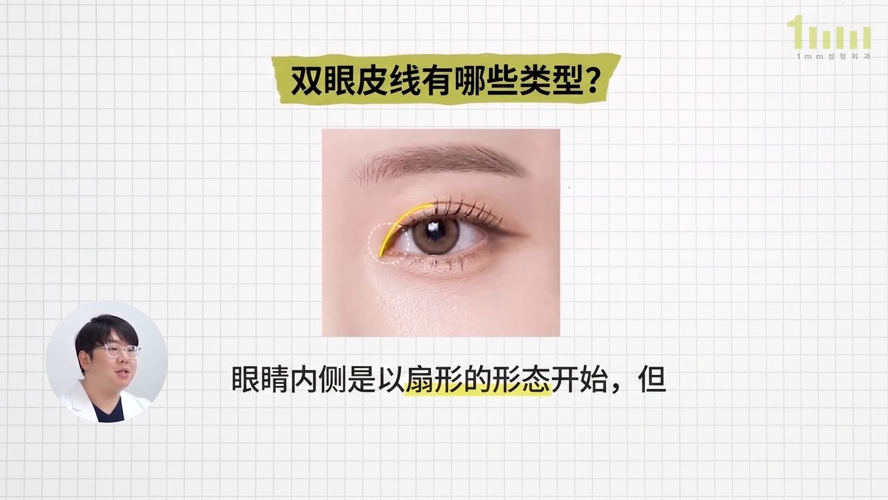 从内眼角内侧开始的双眼皮线以黄线标示的图片，配有视频字幕“眼睛内侧是以扇形的形态开始，但…”