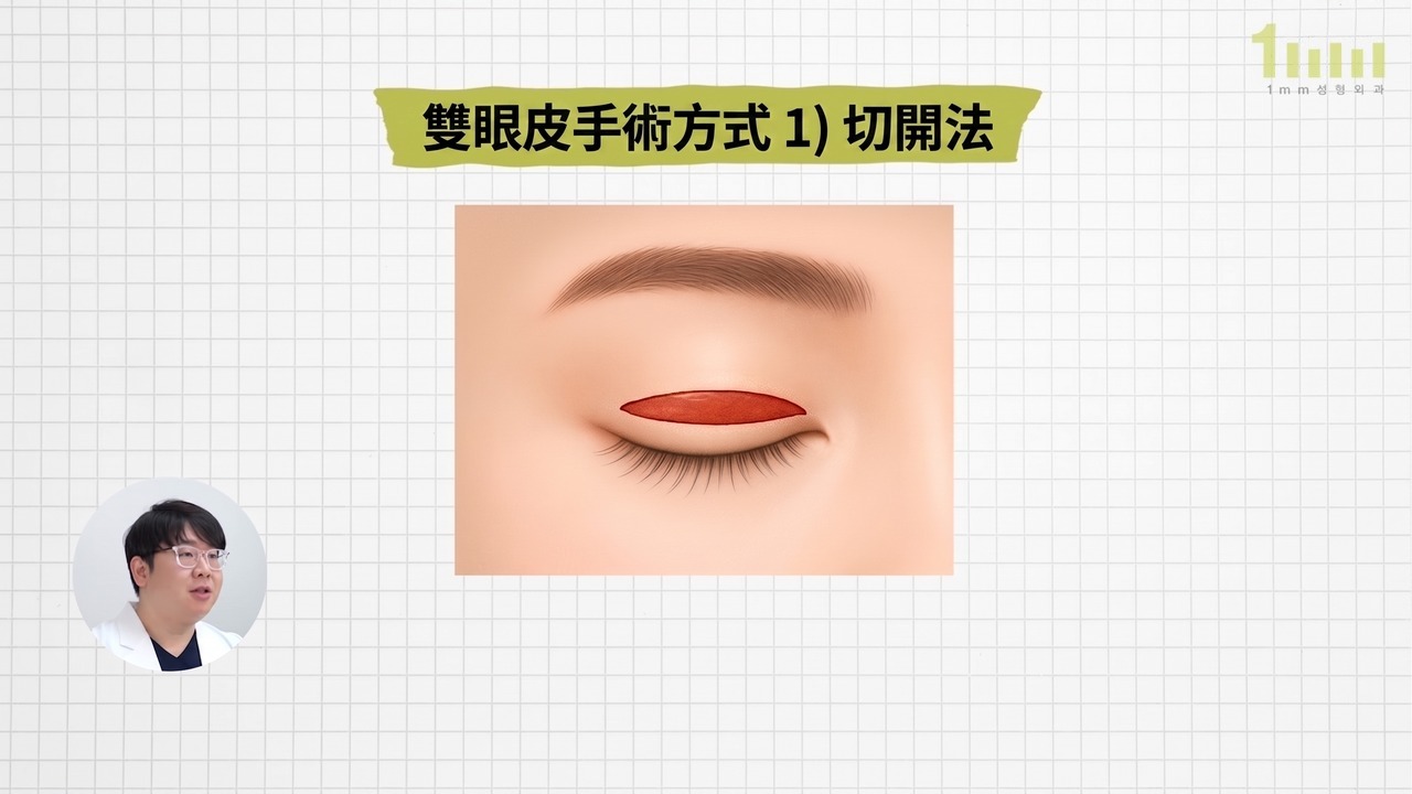 上眼皮切開範圍以紅色區域標示的切開法說明圖