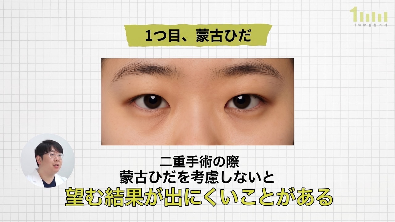 蒙古ひだのある両目を正面から撮影した画像と、「二重手術の際、蒙古ひだを考慮しないと、望む結果が出にくいことがある」という動画字幕