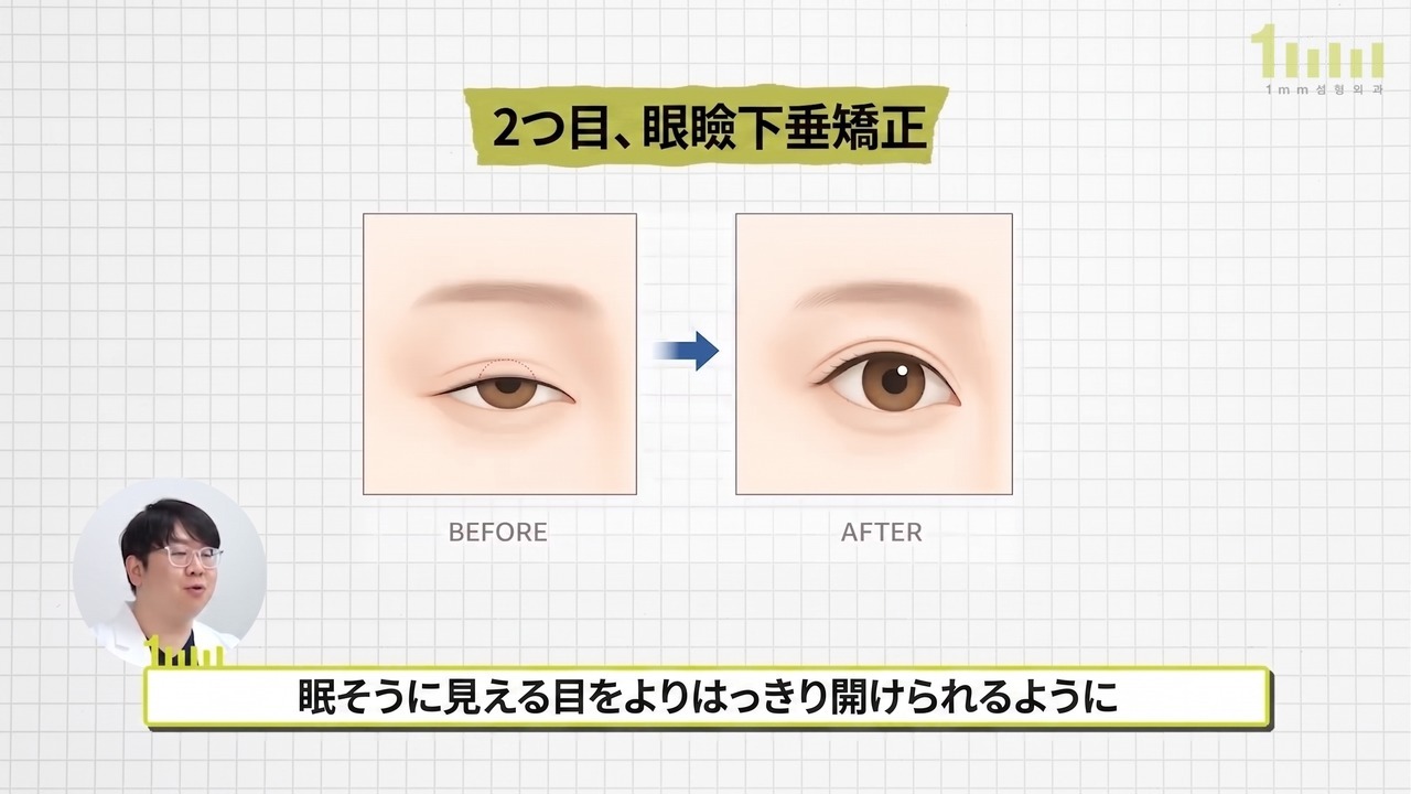 眼瞼下垂矯正の概念を説明する前後比較イラストと、「眠そうに見える目をよりはっきり開けられるように」という動画字幕
