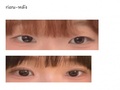 รีวิวหลังใช้งาน 1 เดือนครึ่ง กับการยกกระชับเปลือกตาบนด้วยวิธี Natural Adhesion ของคุณหมอโด ออน-ร็อก