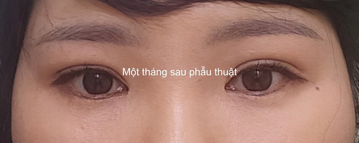 Bác sĩ Do Eon-rok / Phẫu thuật chỉnh sửa mí mắt đôi bằng phương pháp rạch mổ