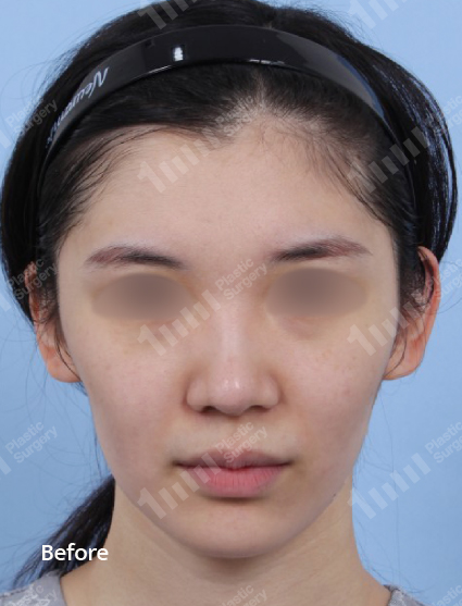Before