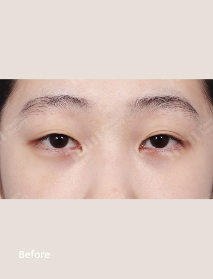 Before