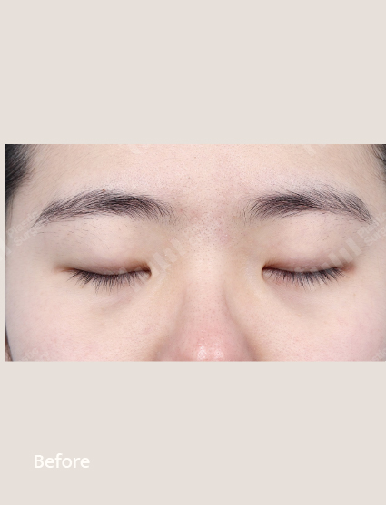 Before