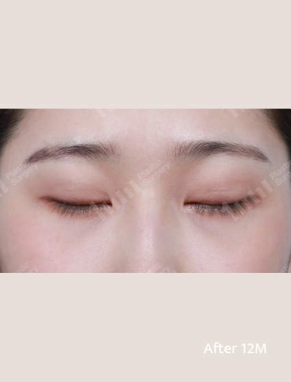 After