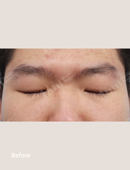 Before