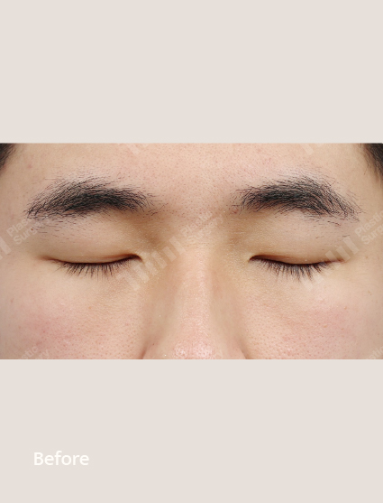 Before