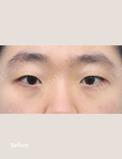 Before