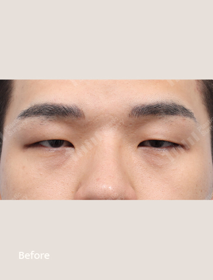 Before