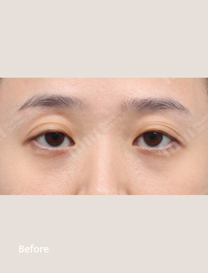 Before