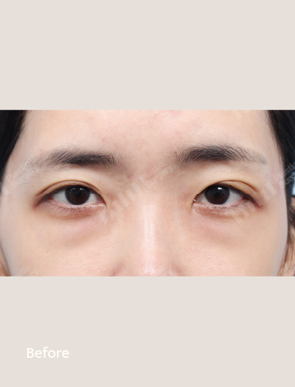 Before