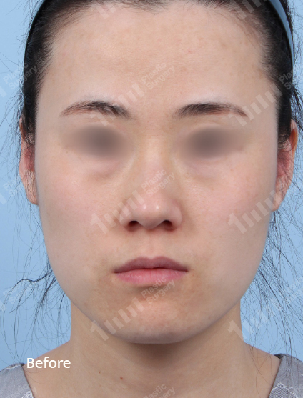 Before