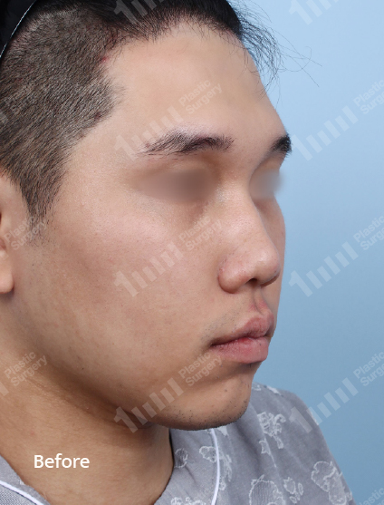 Before