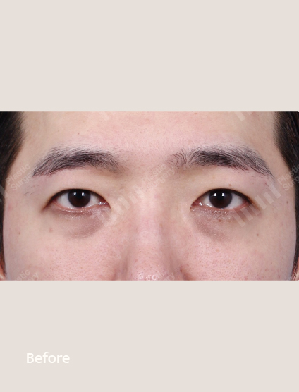 Before