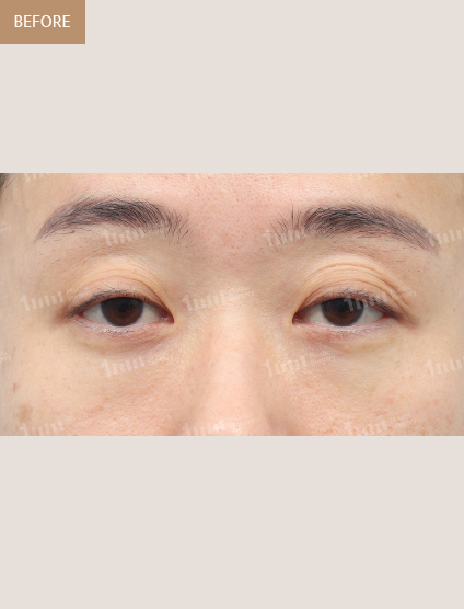 Before